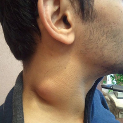 Cancerous Lumps On Neck   Neck Lump 